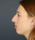 Feel Beautiful - Nose Surgery San Diego 184 - Before Photo